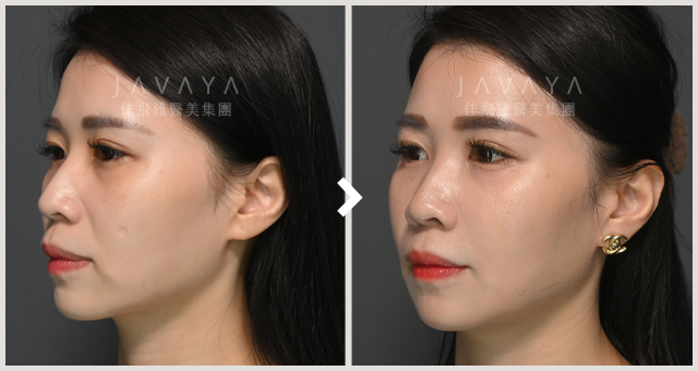 玻尿酸_法令紋填補_01